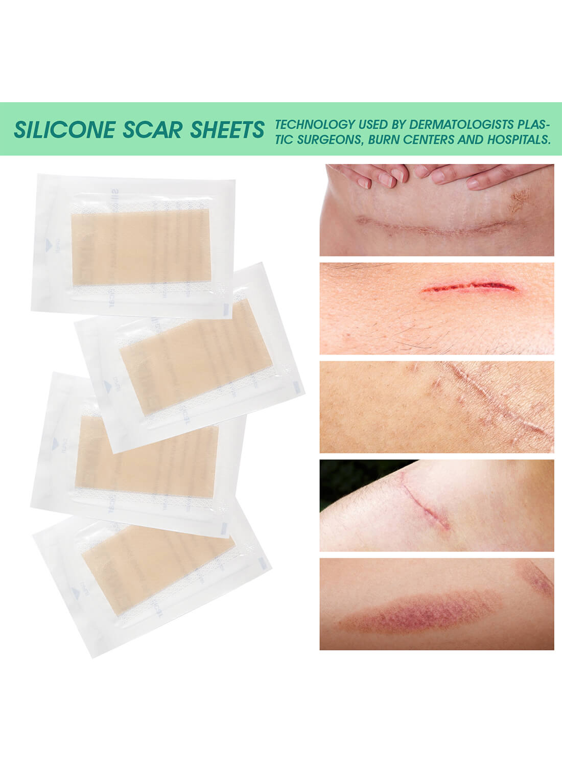 ELAIMEI Silicone Scar Sheets Skin Care 4Pcs