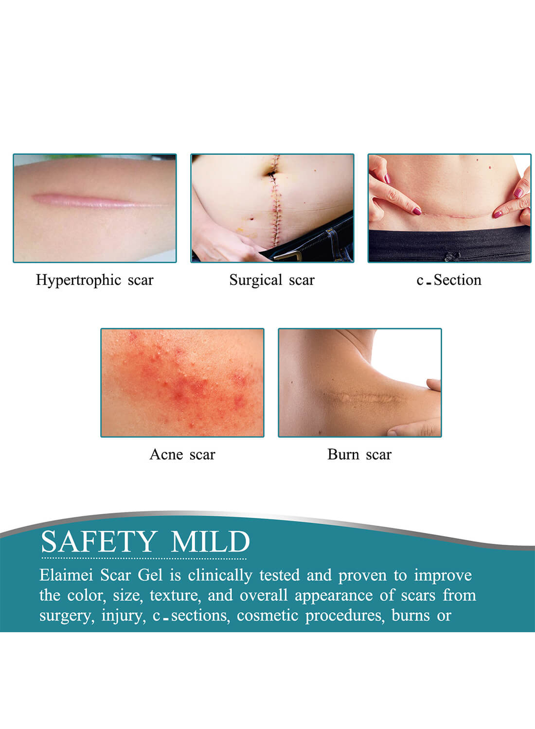 ELAIMEI Silicone Scar Sheets Skin Care 4cm*1.5m