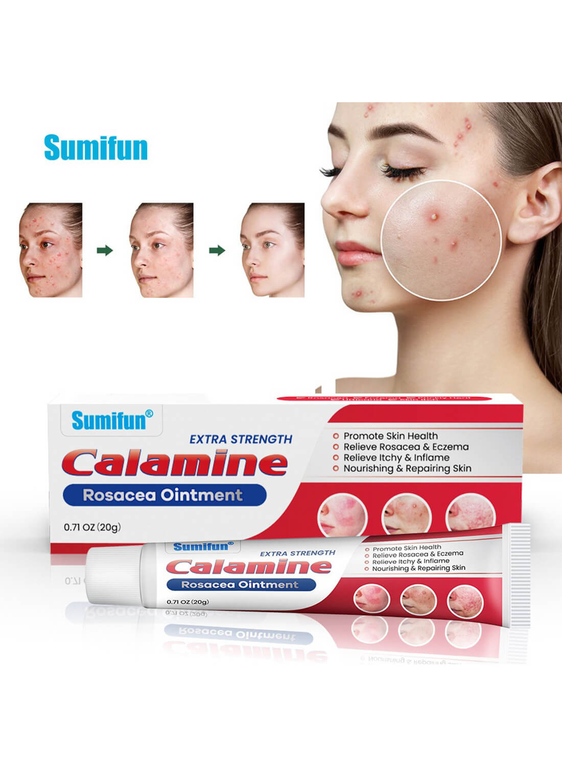 Calamine Rosacea Ointment, Effective Relieve Rosacea and Eczema 20g